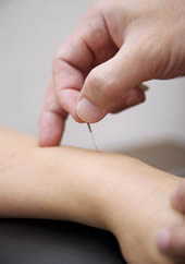 acupuntura